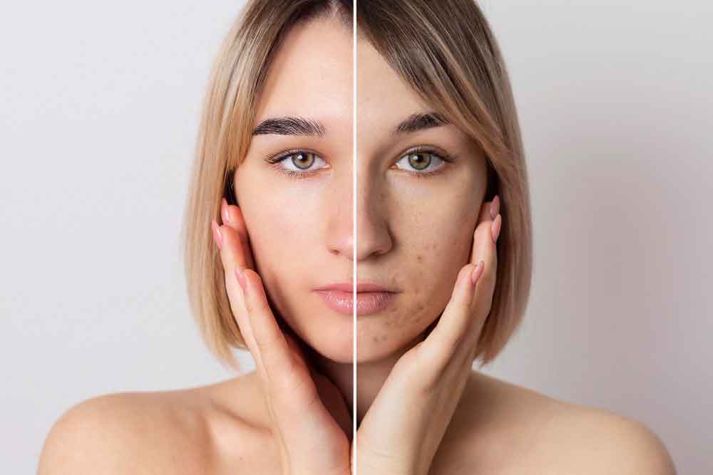 Melasma treatment