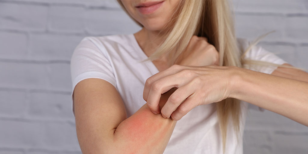 how to treat eczema