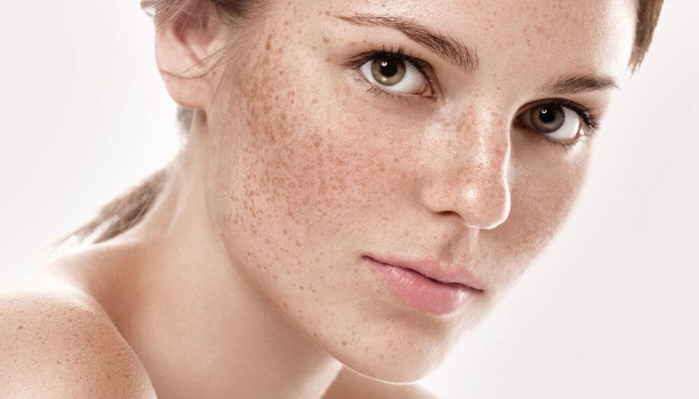 How to get rid of dark spots