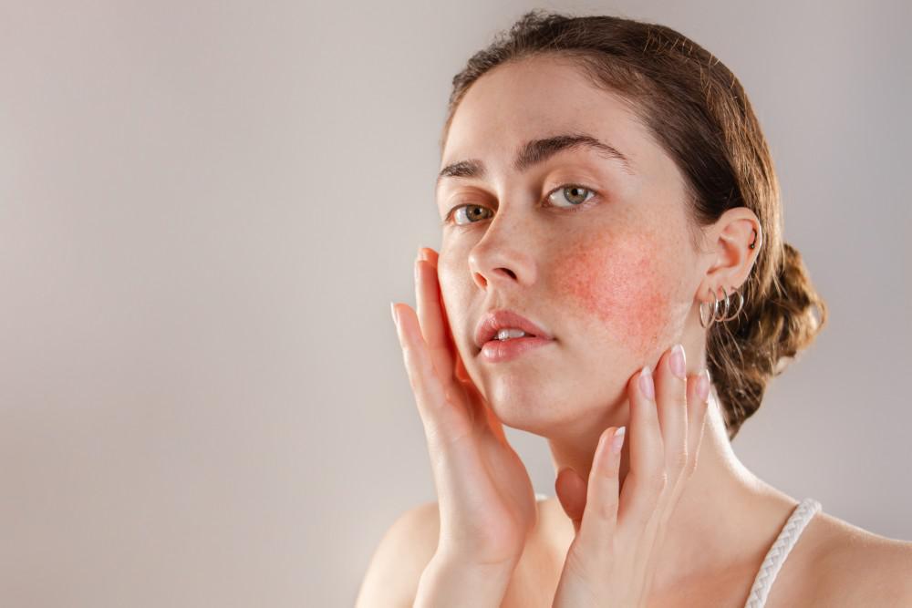 How to calm a rosacea flare-up